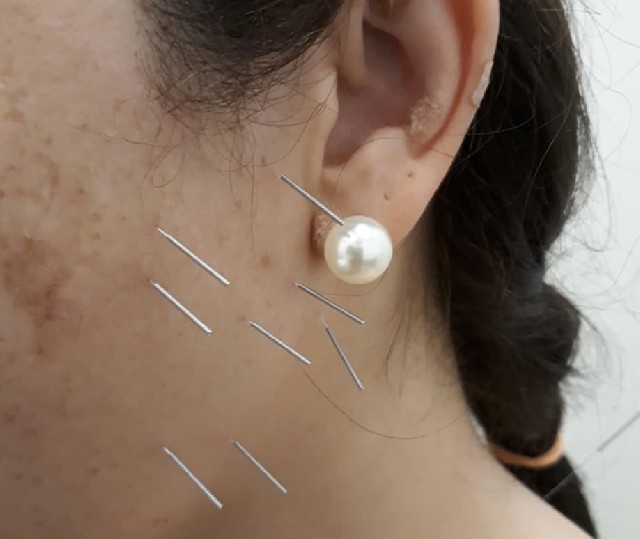 Foto 1 - Massagem e acupuntura